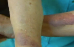 Northington bruises